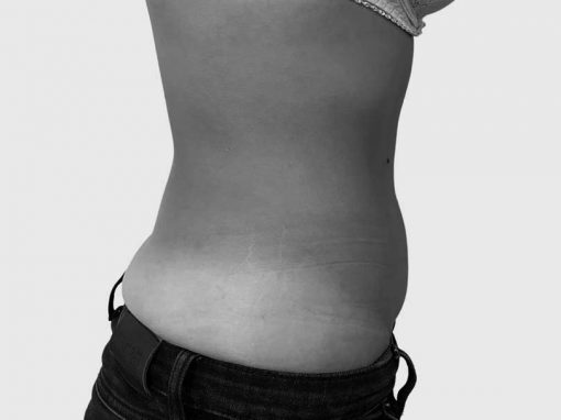 Body Shaping Treatments  Non Surgical Body Shaping & Sculpting