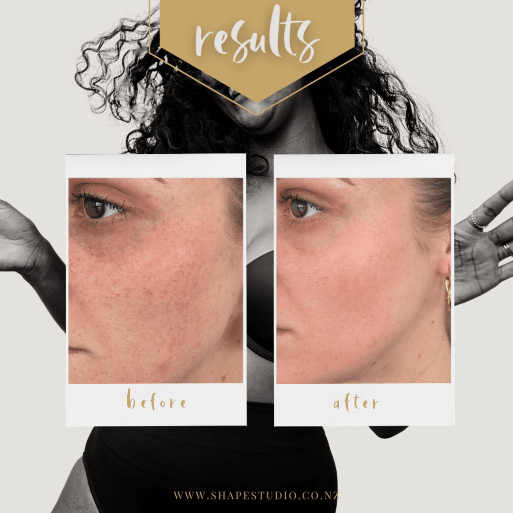 Does Mederma Work On Hyperpigmentation Does Hyperpigmentation Treatment Work? | Shape Studio